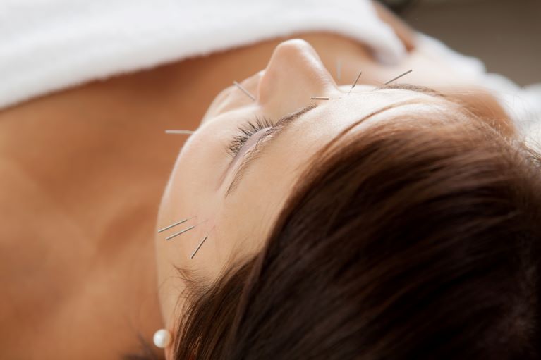 What Is Facial Acupuncture?